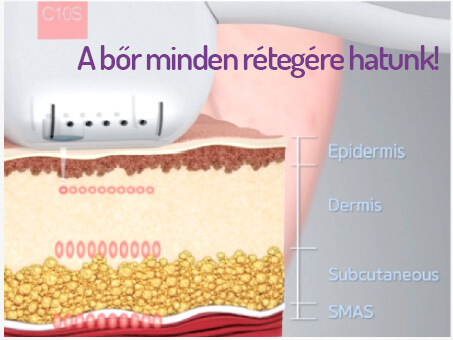 Ultrahang hullámok bejutása a bőrbe